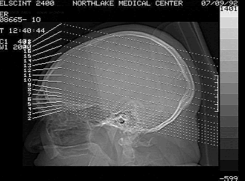 Image of skull x-ray